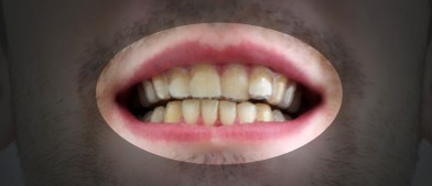 В мире: Студент из Нью-Джерси выравнял зубы благодаря самостоятельно разработанным и распечатанным на 3D-принтере брэкетам