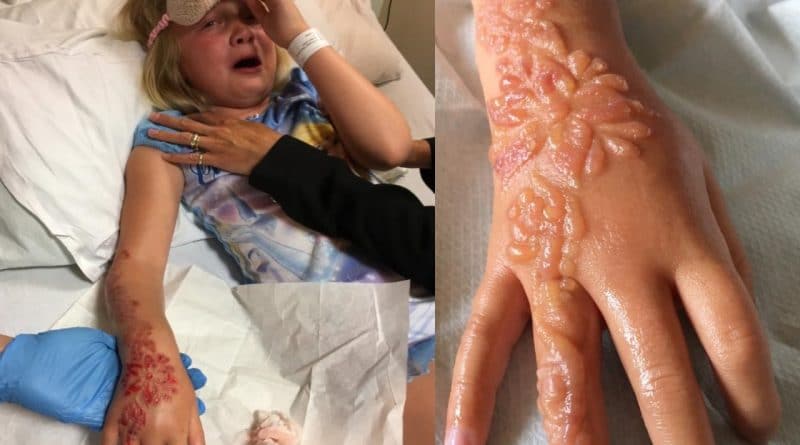 Происшествия: Семилетняя девочка получила химические ожоги от татуировки хной