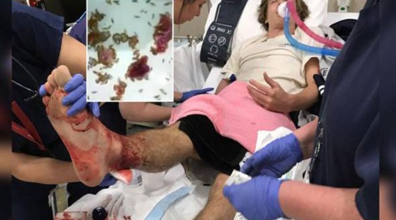 В мире: Неизвестные морские твари чуть не лишили ног австралийского подростка