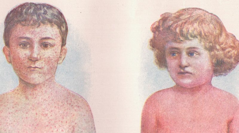 В Великобритании зафиксирован высокий уровень заболевания скарлатиной 28112017 Здоровье и красота: В Великобритании зафиксирован высокий уровень заболевания скарлатиной