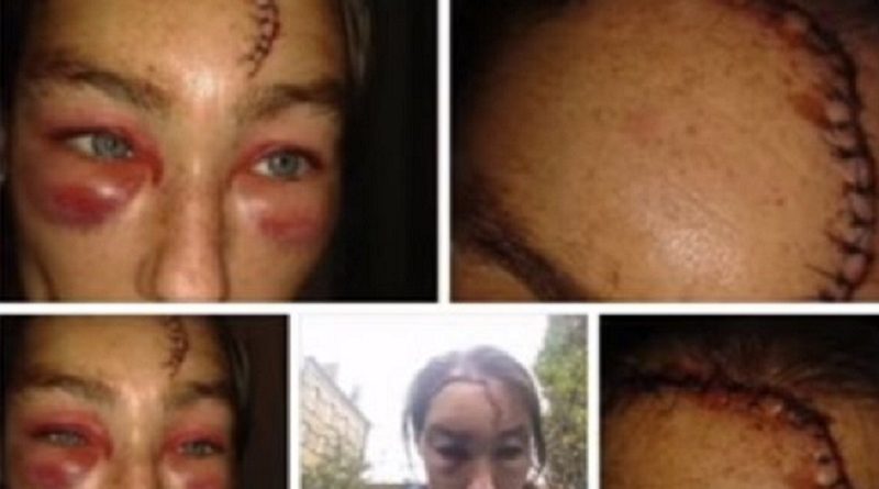 В Западном Йоркшире расисты изуродовали женщину 30112017 Происшествия: В Западном Йоркшире расисты изуродовали женщину