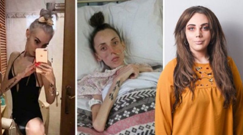 Здоровье и красота: Анорексия: неосведомленность о болезни поражает