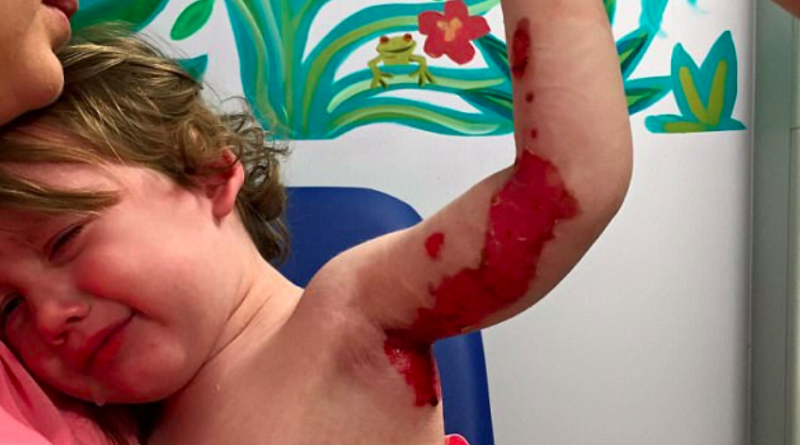 Детский сад выплатит компенсацию матери, чей ребенок опрокинул на себя чашку горячего чая 22012018 Происшествия: Детский сад выплатит компенсацию матери, чей ребенок опрокинул на себя чашку горячего чая