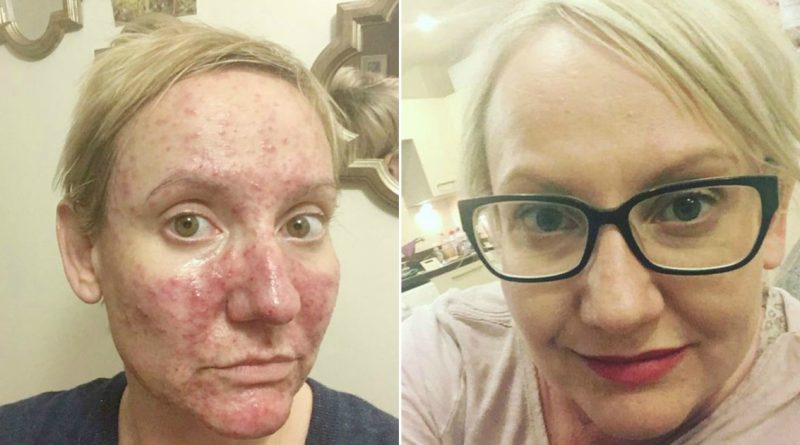 Здоровье и красота: Врачи отрицали, что у женщины рак, пока опухоль не выросла размером с апельсин