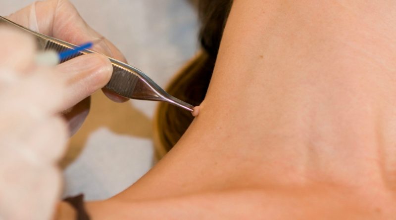 Как избавиться от бородавок и другие советы дерматолога 03042018 Здоровье и красота: Как избавиться от бородавок и другие советы дерматолога