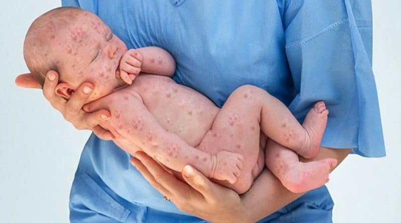 Вспышка кори: в Англии зарегистрировали 400 случаев заболевания этой болезнью 14052018 Здоровье и красота: Вспышка кори: в Англии зарегистрировали 400 случаев заболевания этой болезнью