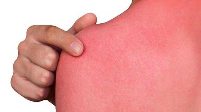 Еще успеваем: дерматолог рассказал, как справиться с солнечным ожогом 26052018 Здоровье и красота: Еще успеваем: дерматолог рассказал, как справиться с солнечным ожогом