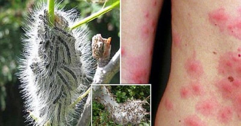 Здоровье и красота: Британия переживает нашествие токсичных гусениц, вызывающих астму, тошноту и сыпь на коже