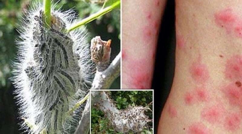 Британия переживает нашествие токсичных гусениц, вызывающих астму, тошноту и сыпь на коже 07052018 Здоровье и красота: Британия переживает нашествие токсичных гусениц, вызывающих астму, тошноту и сыпь на коже