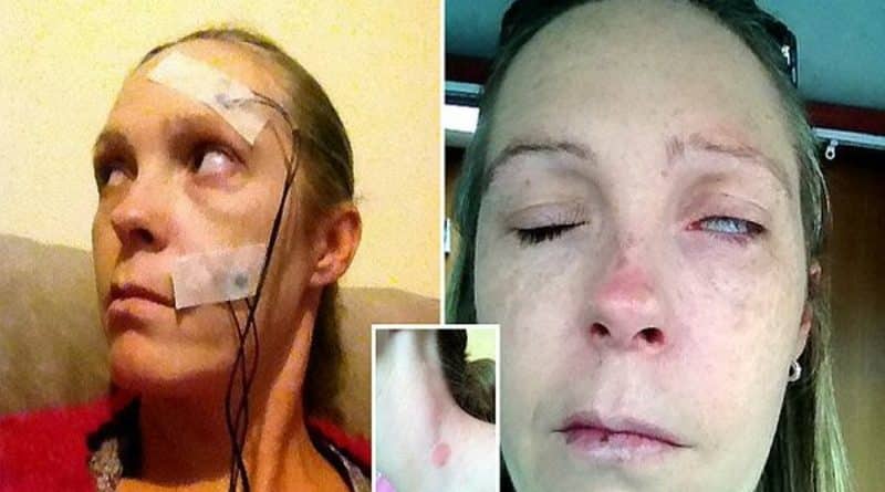 Здоровье и красота: Осторожно, клещи! NHS отказывается поставить женщине диагноз при всех симптомах клещевого боррелиоза