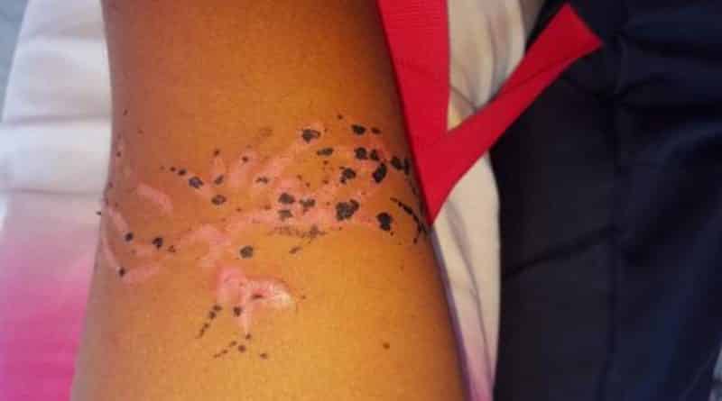 Здоровье и красота: Мама разрешила детям сделать тату хной, но взамен они получили ожоги и шрамы на всю жизнь