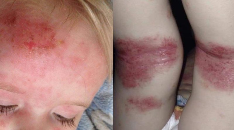 Ребенок выглядел как жертва ожогов в течение многих лет, но вылечился "чудо-кремом" за неделю 17092018 Здоровье и красота: Ребенок выглядел как жертва ожогов в течение многих лет, но вылечился "чудо-кремом" за неделю