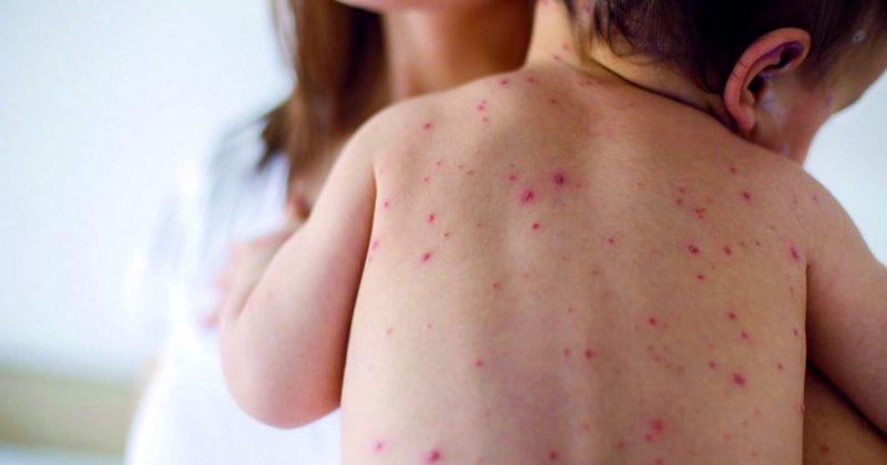 Здоровье и красота: Рейтинг прививок снова упал: дети Великобритании под угрозой смертельного менингита и кори