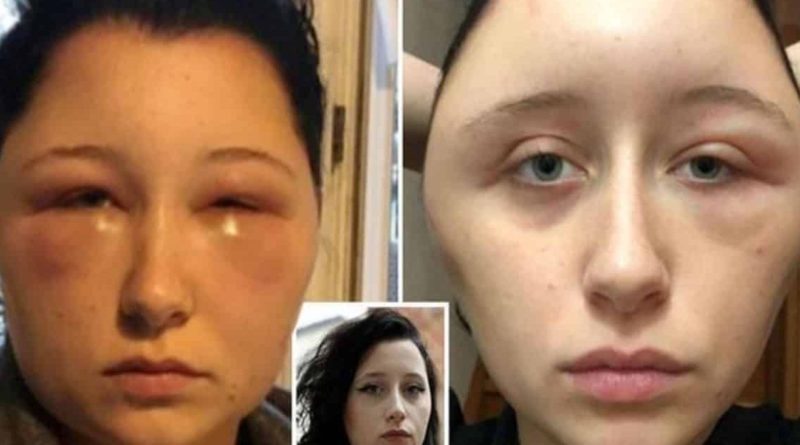 Голова девушки удвоилась после использования краски для волос 30112018 Здоровье и красота: Голова девушки удвоилась после использования краски для волос