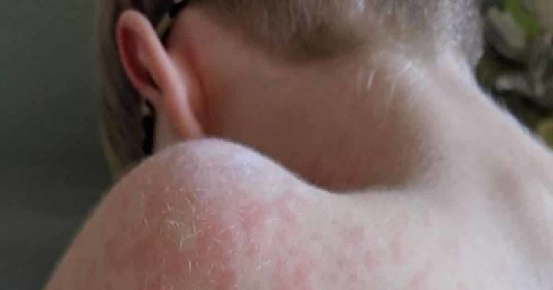 Здоровье и красота: В Манчестере 8-летний мальчик заразился корью, несмотря на 2 прививки