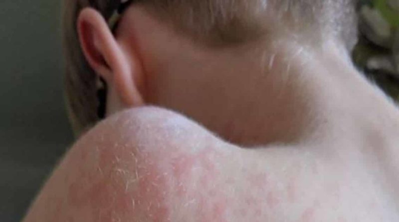 В Манчестере 8-летний мальчик заразился корью, несмотря на 2 прививки 14122018 Здоровье и красота: В Манчестере 8-летний мальчик заразился корью, несмотря на 2 прививки