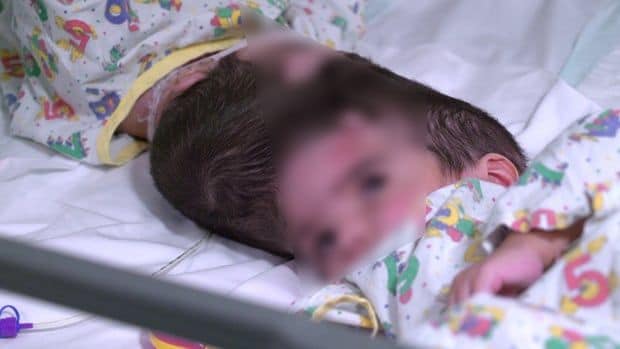 Происшествия: Британским медикам удалось разделить сиамских близнецов сросшихся головами