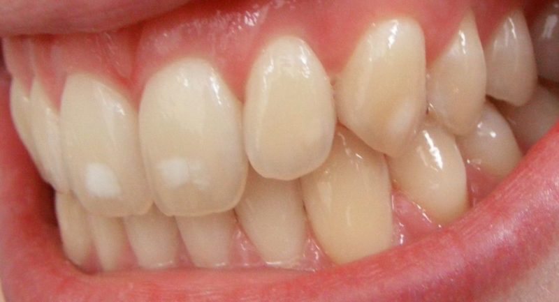 Общество: Установлен новый подход выращивания наноэмали на зубах