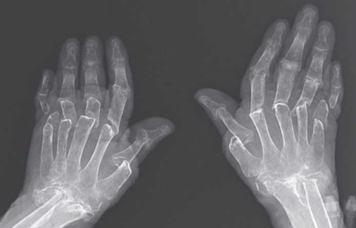 Общество: К турецким врачам пришла пациентка с раздвижными пальцами рук