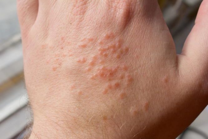 Общество: Высыпания на коже — новый cимптом коронавируса (COVID-19)