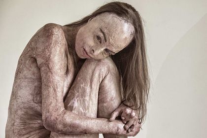Общество: Женщина с ожогами по всему телу снялась обнаженной и поделилась ощущениями