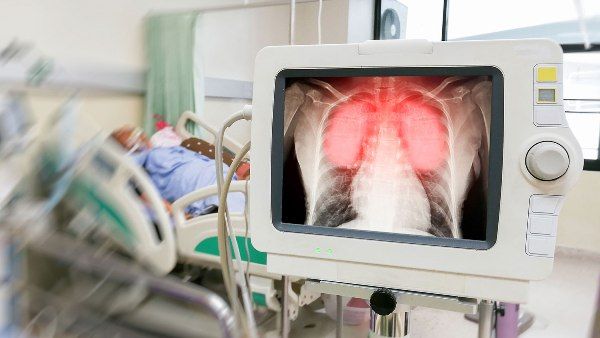 Общество: Covid-19 ведёт к длительным повреждениям лёгких у пациентов — исследования