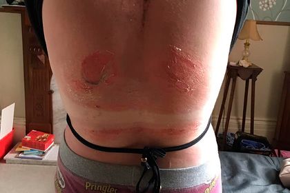 Общество: Волдыри на спине девушки после пляжного отдыха перепугали пользователей сети